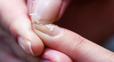 TIRNAKLARDA 8 ÖNEMLİ HASTALIK SİNYALİ! 